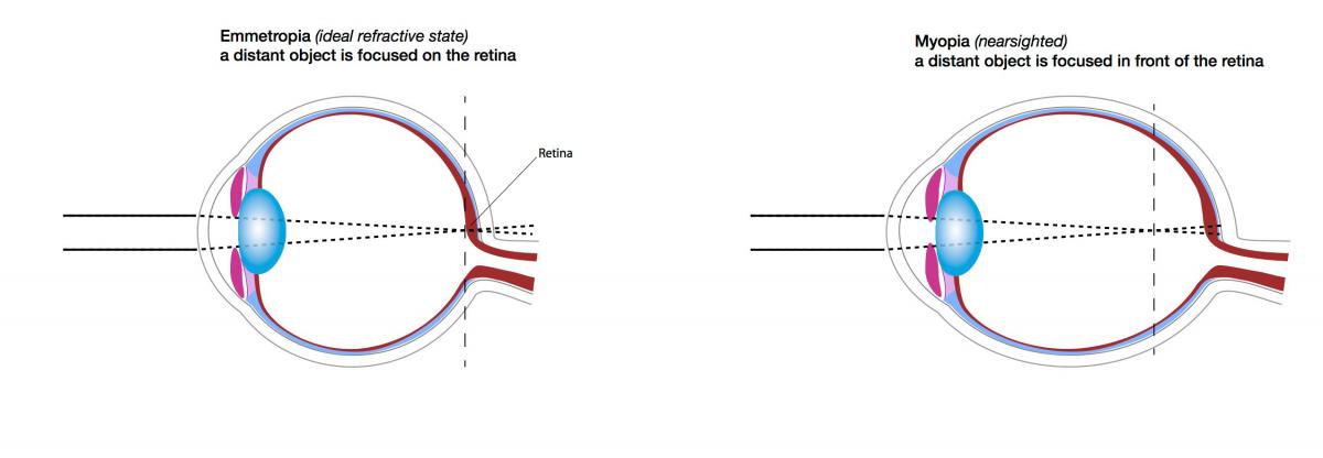 Emmetropic-and-Myopic-Eyes